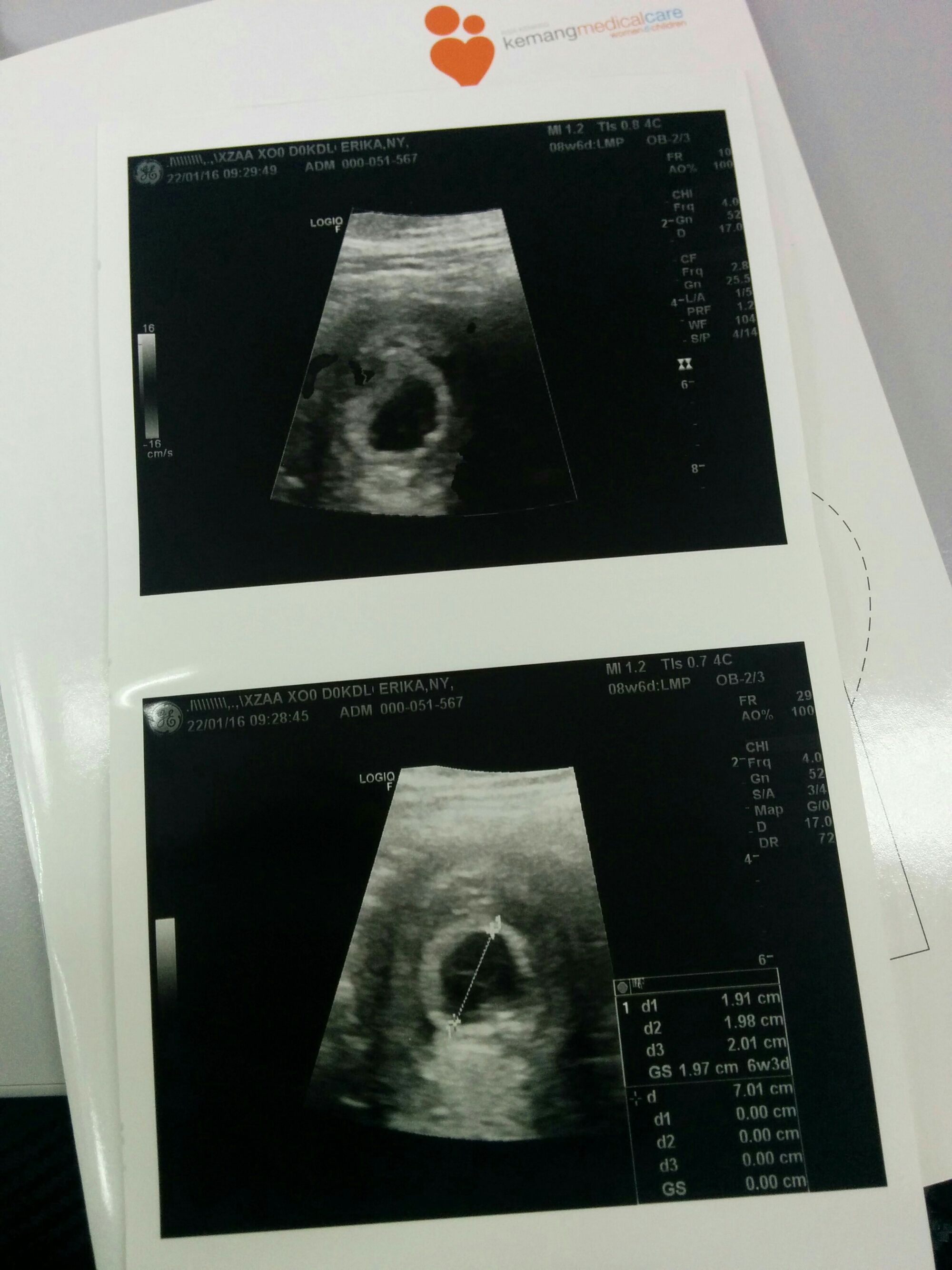 1 Minggu Setelah Dokter Mem Vonis Blighted Ovum Kehamilan